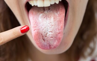 Cómo combatir la halitosis: consejos prácticos para mantener un aliento fresco