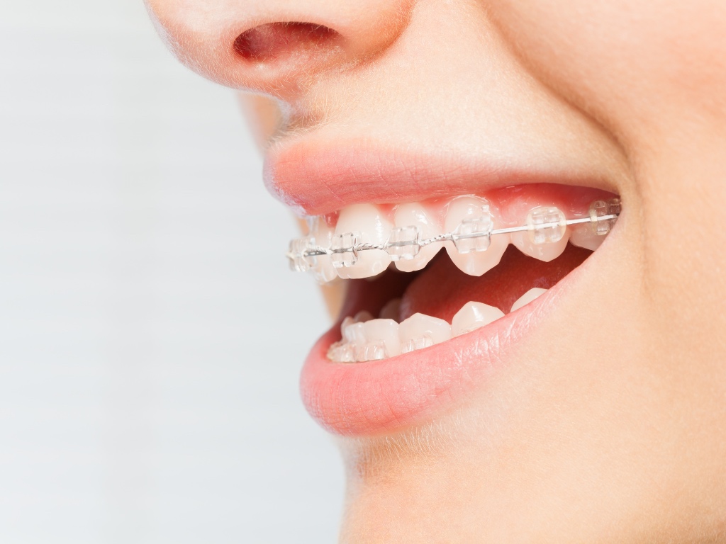 invisalign-o-brackets-comparacion